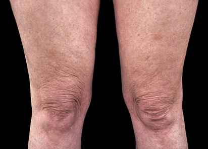 Emtone_PIC_025-Before-legs-female-BTL-Aesthetics_412x296_1589437106_original