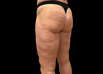 Emtone_PIC_027-Before-buttock-female-Giulia-Bianchi_412x296_1589783352_original