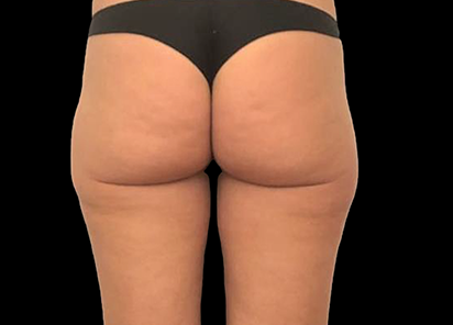 Emtone_PIC_028-After-buttock-female-Giulia-Bianchi-3TX_412x296_1589783354_original
