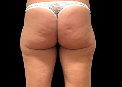 Emtone_PIC_028-Before-buttock-female-Giulia-Bianchi_412x296_1589783356_original