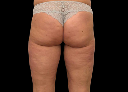 Emtone_PIC_029-After-buttock-female-Giulia-Bianchi-4TX_412x296_1589783358_original