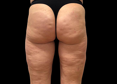 Emtone_PIC_029-Before-buttock-female-Giulia-Bianchi_412x296_1589783360_original