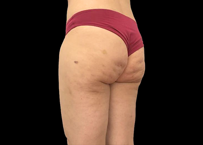 Emtone_PIC_030-After-buttock-female-Giulia-Bianchi-3TX_412x296_1589783362_original