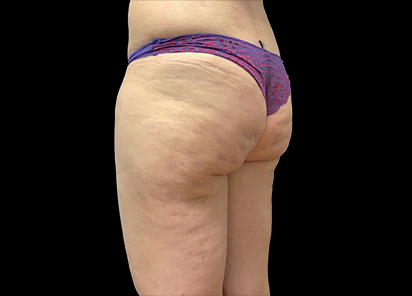 Emtone_PIC_030-Before-buttock-female-Giulia-Bianchi_412x296_1589783364_original