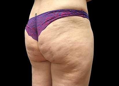 Emtone_PIC_031-Before-buttock-female-Giulia-Bianchi_412x296_1589783368_original