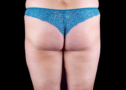 Emtone_PIC_34-After-buttock-female-Brian-Kinney-4TX_412x296_1589785406_original