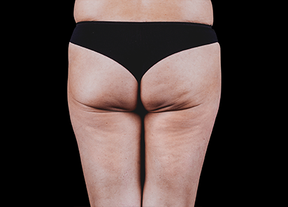 Emtone_PIC_35-Before-buttock-female-Brian-Kinney_412x296_1589783371_original