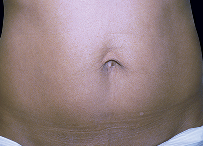 Exilis_PIC_105-After-abdomen-female-Downie-Jeannie-B.-Downie-MD-4TX_412x296px_1589885105_original