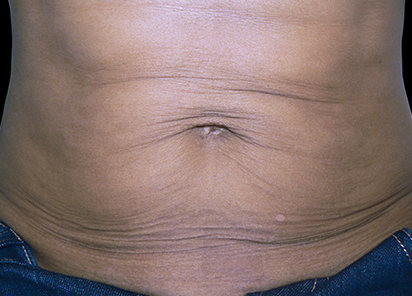 Exilis_PIC_105-Before-abdomen-female-Jeannie-B.-Downie-MD_412x296px_1589885106_original