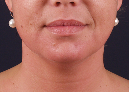 Exilis_PIC_116-After-neck-female-Katerina-Fajkosova-MD-4TX_412x296px_1589888587_original