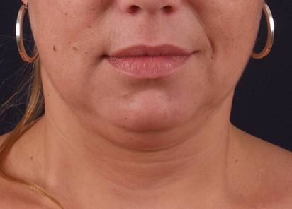 Exilis_PIC_116-Before-neck-female-Katerina-Fajkosova-MD_412x296px_1589888589_original