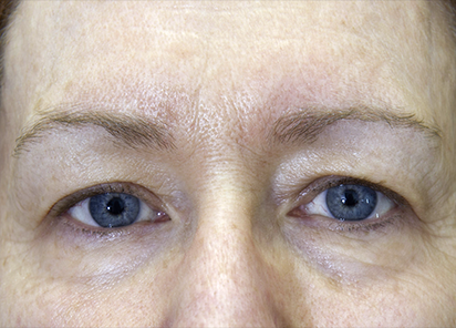 Exilis_PIC_261-After-eyes-female-Hartsough-2TX_412x296px_1589889293_original