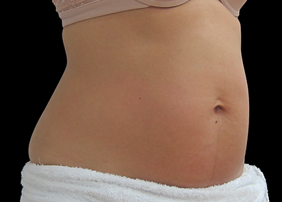 Exilis_System_PIC_006-After-abdomen-female-BTL-Aesthetics-4TX_412x296px_1589885108_original