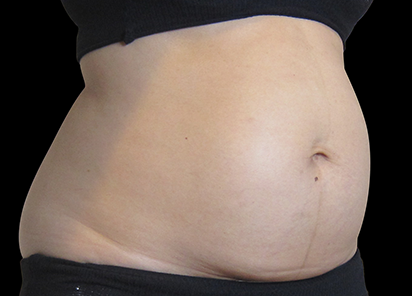 Exilis_System_PIC_006-Before-abdomen-female-BTL-Aesthetics_412x296px_1589885110_original