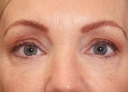 Exilis_Ultra_360_PIC_103-After-eyes-female-Suneel-Chilukuri-MD-2TX_412x296px_1589435827_original