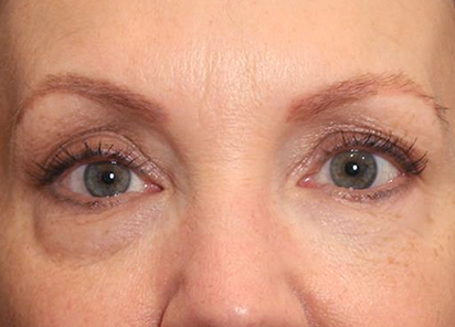 Exilis_Ultra_360_PIC_103-Before-eyes-female-Suneel-Chilukuri-MD_412x296px_1589435829_original