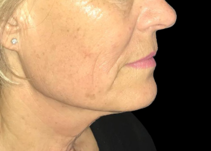 Exilis_Ultra_360_PIC_108-After-face-neck-female-Jaye-Bird-Aesthetics-Clinic-4TX_412x296px_1589888595_original