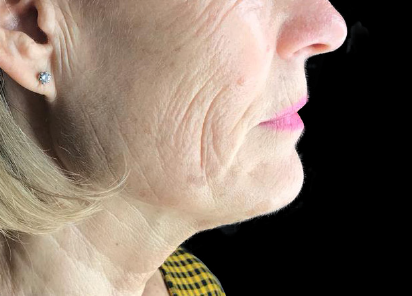 Exilis_Ultra_360_PIC_108-Before-face-neck-female-Jaye-Bird-Aesthetics-Clinic_412x296px_1589888597_original