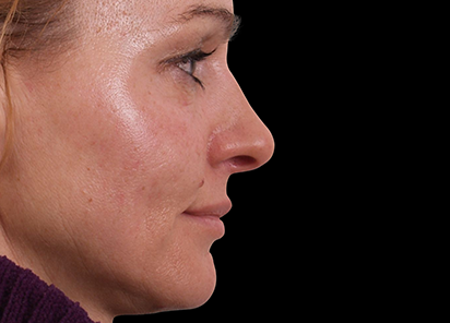 Exilis_Ultra_360_PIC_109-After-face-neck-female-BTL-Aesthetics-4TX_412x296px_1589888599_original