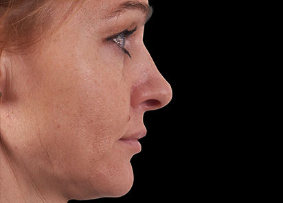 Exilis_Ultra_360_PIC_109-Before-face-neck-female-BTL-Aesthetics_412x296px_1589888601_original