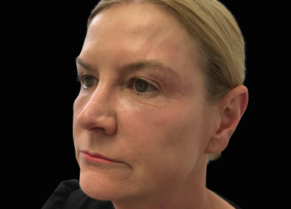 Exilis_Ultra_360_PIC_110-After-face-neck-female-Jaye-Bird-Aesthetics-Clinic-5TX_412x296px_1589888602_original