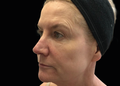 Exilis_Ultra_360_PIC_110-Before-face-neck-female-Jaye-Bird-Aesthetics-Clinic_412x296px_1589888604_original