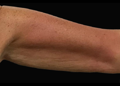 Exilis_Ultra_360_PIC_113-After-arms-female-BTL-Aesthetics-4TX_412x296px_1589885320_original