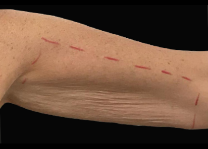 Exilis_Ultra_360_PIC_113-Before-arms-female-BTL-Aesthetics_412x296px_1589885322_original