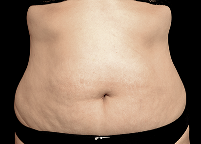 Exilis_Ultra_PIC_001-After-abdomen-female-Dominique-Denjean-DR-4TX_412x296px_1589885112_original