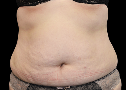 Exilis_Ultra_PIC_001-Before-abdomen-female-Dominique-Denjean-DR_412x296px_1589885113_original