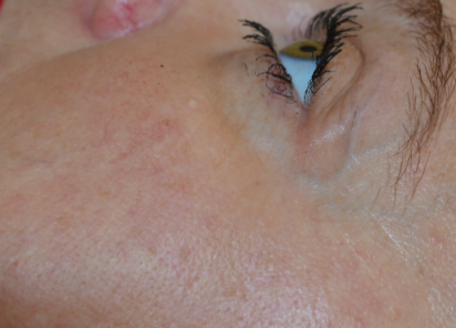 Exilis_Ultra_PIC_002-After-face-female-Linda-Fouque-DR-4TX_412x296px_1589889297_original