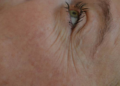 Exilis_Ultra_PIC_002-Before-face-female-Linda-Fouque-DR_412x296px_1589889299_original