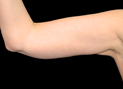 Exilis_Ultra_PIC_003-After-arms-female-BTL-Aesthetics-4TX_412x296px_1589885325_original