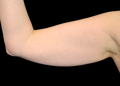 Exilis_Ultra_PIC_003-Before-arms-female-BTL-Aesthetics_412x296px_1589885327_original