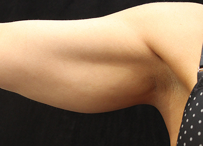 Exilis_Ultra_PIC_019-After-arms-female-Suneel-Chilukuri-MD-4TX_412x296px_1589435747_original