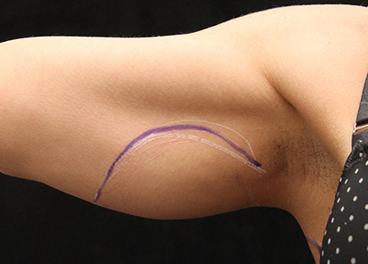 Exilis_Ultra_PIC_019-Before-arms-female-Suneel-Chilukuri-MD_412x296px_1589435749_original