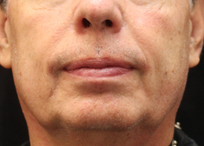 Exilis_Ultra_PIC_051-After-face-male-Suneel-Chilukuri-MD-2TX_412x296px_1589888612_original