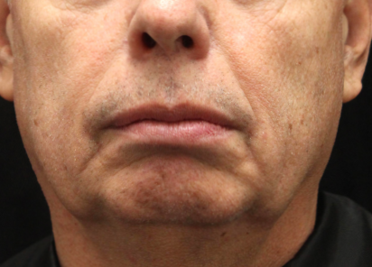 Exilis_Ultra_PIC_051-Before-face-male-Suneel-Chilukuri-MD_412x296px_1589888614_original