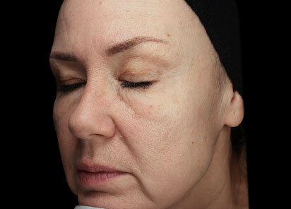 Exion_PIC_091-After-face-female-BTL-Aesthetics-1M_412x296px_1726475935_original