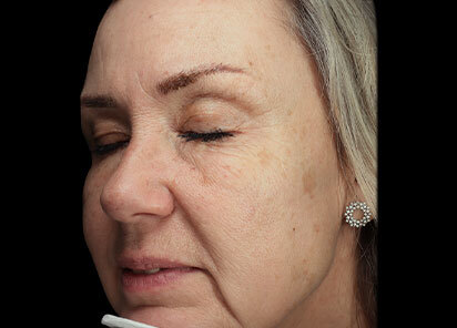 Exion_PIC_091-Before-face-female-BTL-Aesthetics_412x296px_1726475935_original