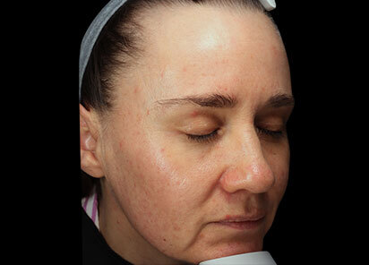 Exion_PIC_093-After-face-female-BTL-Aesthetics-1M_412x296px_1726475936_original