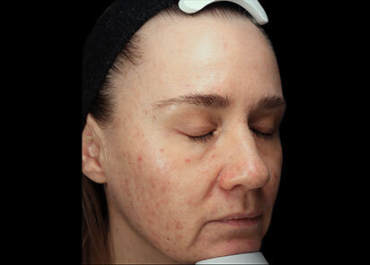 Exion_PIC_093-Before-face-female-BTL-Aesthetics_412x296px_1726475936_original