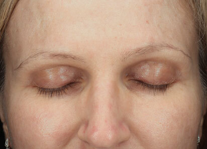 Exion_PIC_094-After-face-female-BTL-2M-2TX_412x296px_1726475937_original