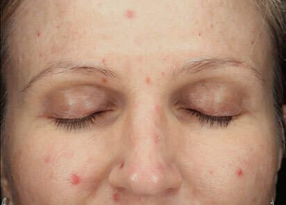 Exion_PIC_094-Before-face-female-BTL_412x296px_1726475937_original