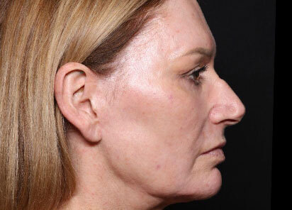 Exion_PIC_096-After-face-female-Diane-Duncan-MD-1M-1TX_412x296px_1726475939_original