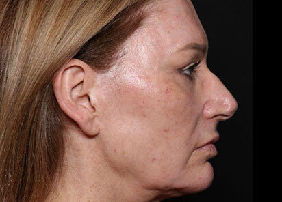 Exion_PIC_096-Before-face-female-Diane-Duncan-MD_412x296px_1726475939_original