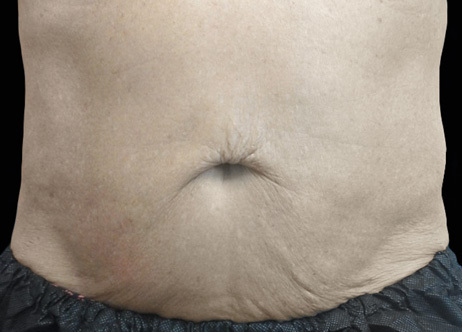 Exion_PIC_Ba-card-abdomen-male-019_Body_After_ENUS100_1688740931_original