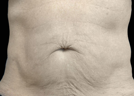 Exion_PIC_Ba-card-abdomen-male-019_Body_Before_ENUS100_1688740930_original