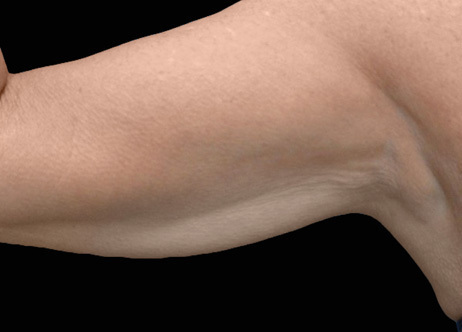 Exion_PIC_Ba-card-arms-female-042_Body_After_ENUS100_1688740911_original