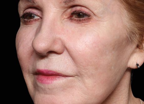 Exion_PIC_Ba-card-cheek-female-004_FRF_After_ENUS100_1688740545_original